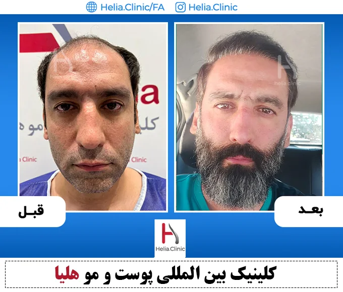 تصاویر کاشت مو به روش fut