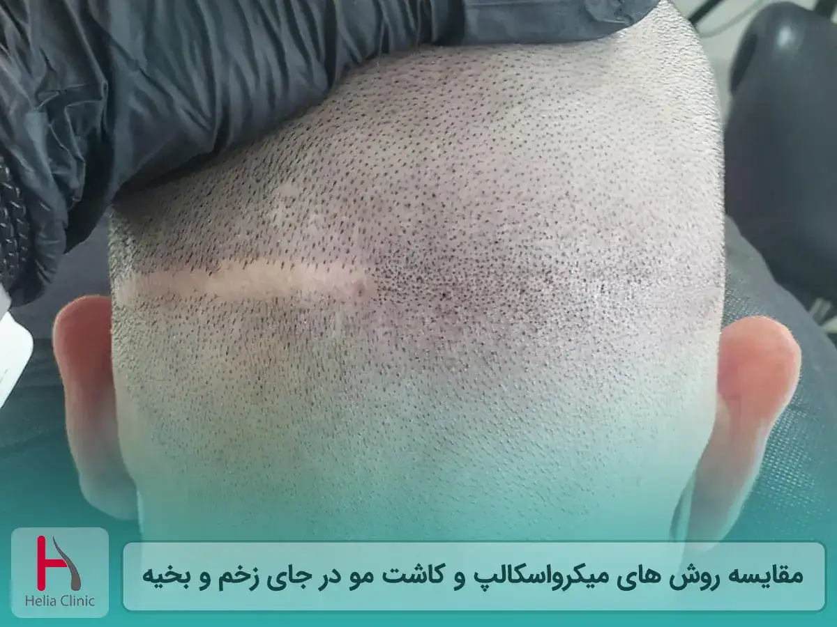 مقایسه روش های میکرواسکالپ و کاشت مو در جای زخم و بخیه