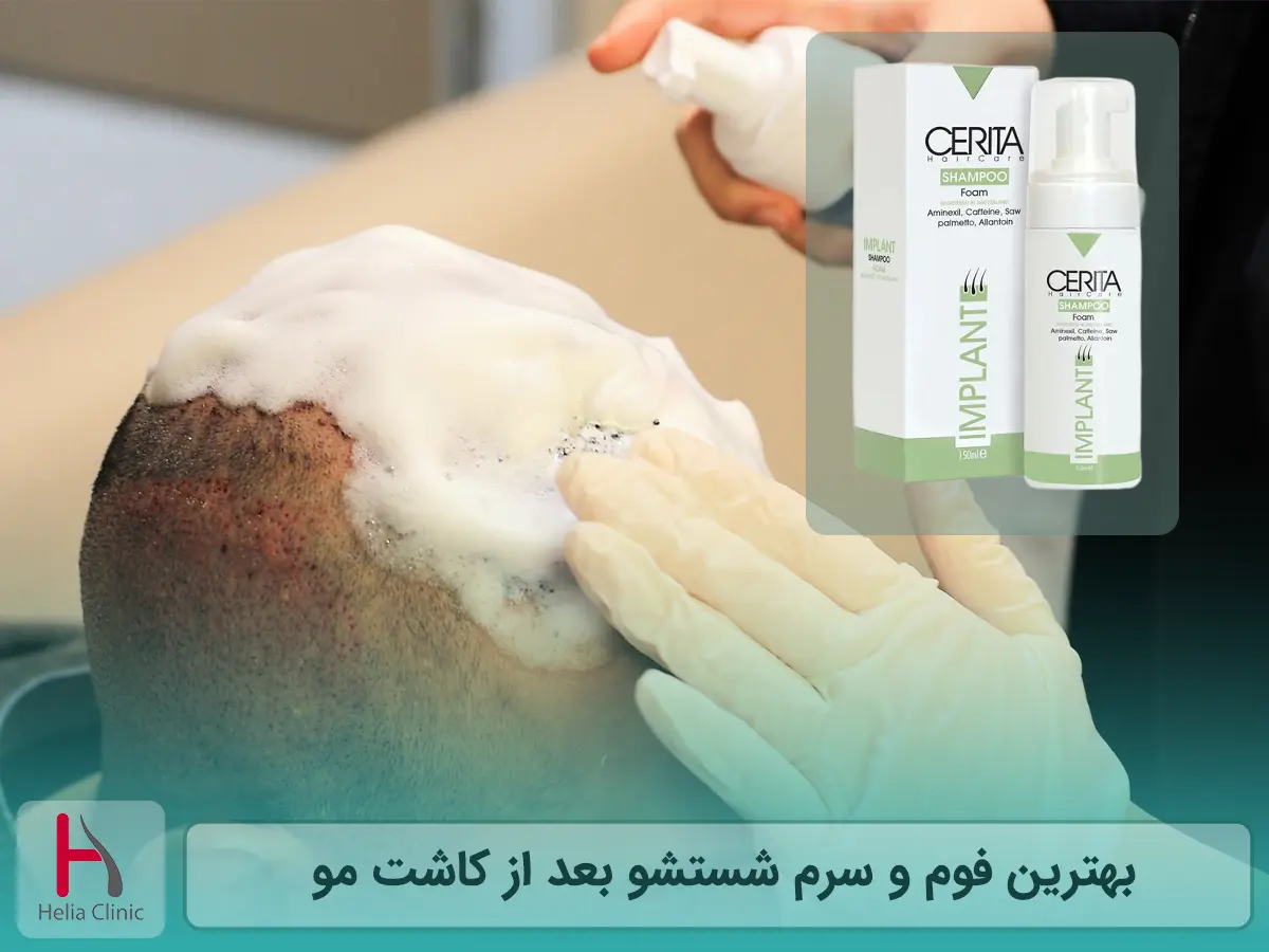 بهترین فوم و سرم شستشو بعد از کاشت مو