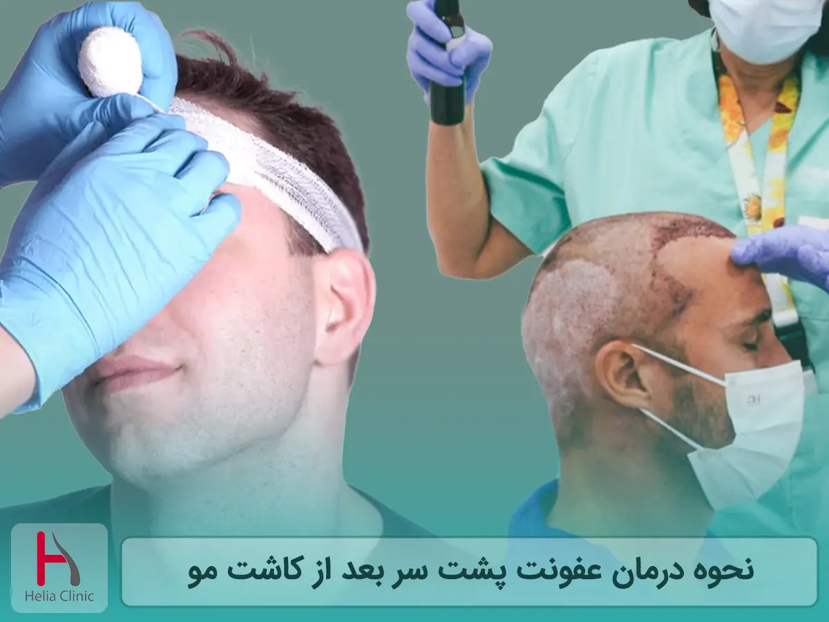 نحوه درمان عفونت پشت سر بعد از کاشت مو
