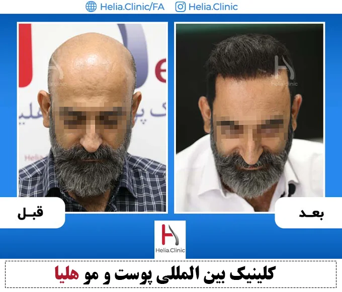 نتیجه پیوند مو با شیوه اف یو تی