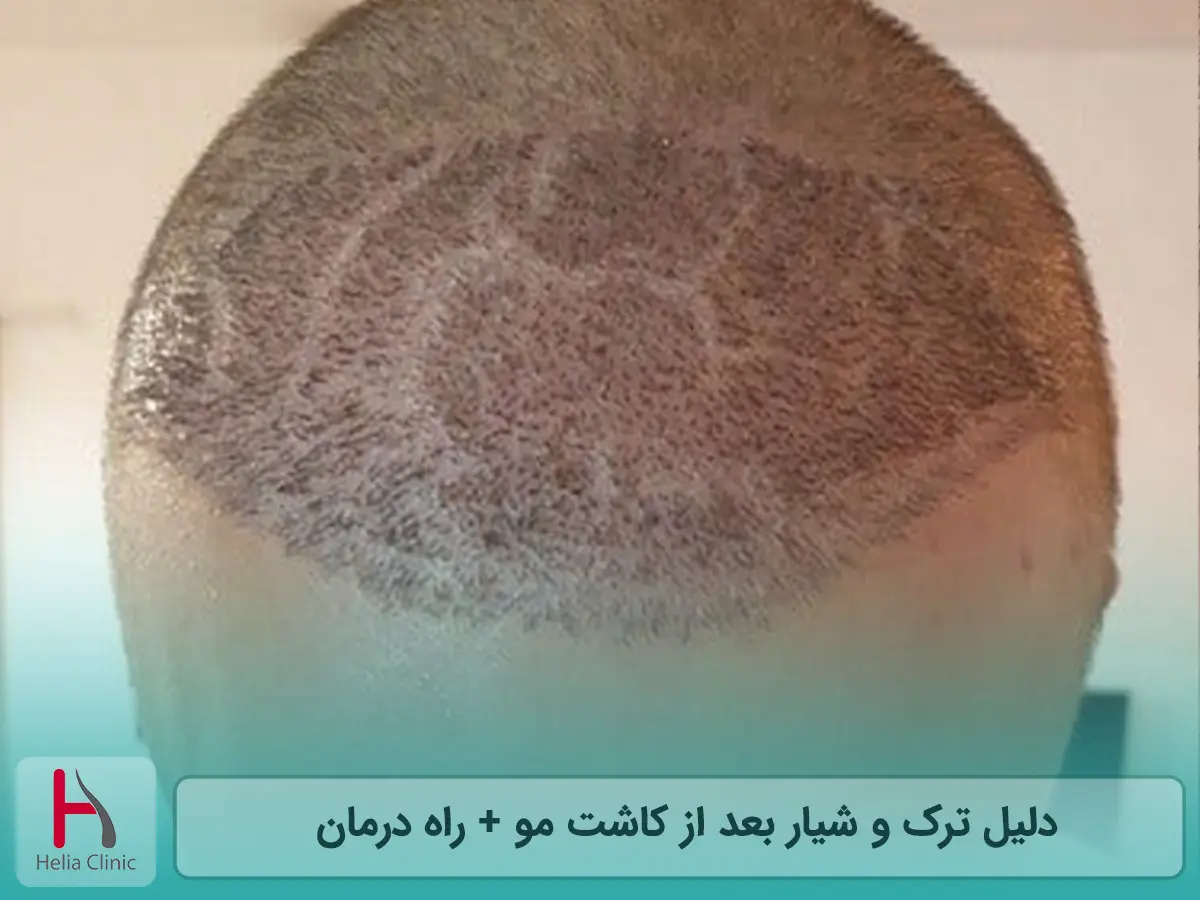 دلیل ترک و شیار بعد از کاشت مو + راه درمان