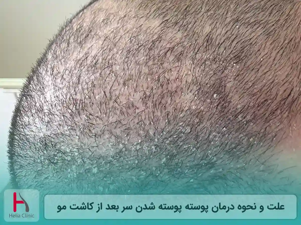 علت و نحوه درمان پوسته پوسته شدن سر بعد از کاشت مو