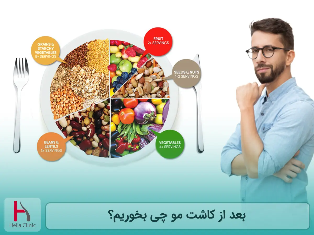 بعد از کاشت مو چه بخوریم؟