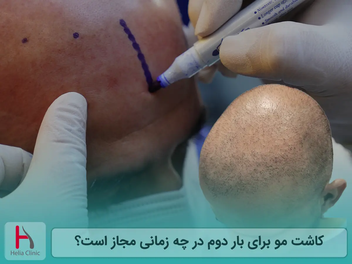 کاشت مو برای بار دوم در چه زمانی مجاز است؟