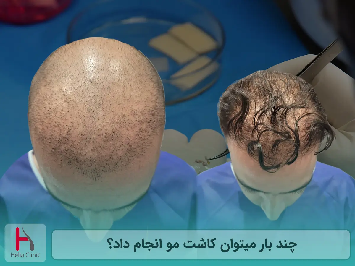 چند بار میتوان کاشت مو انجام داد؟
