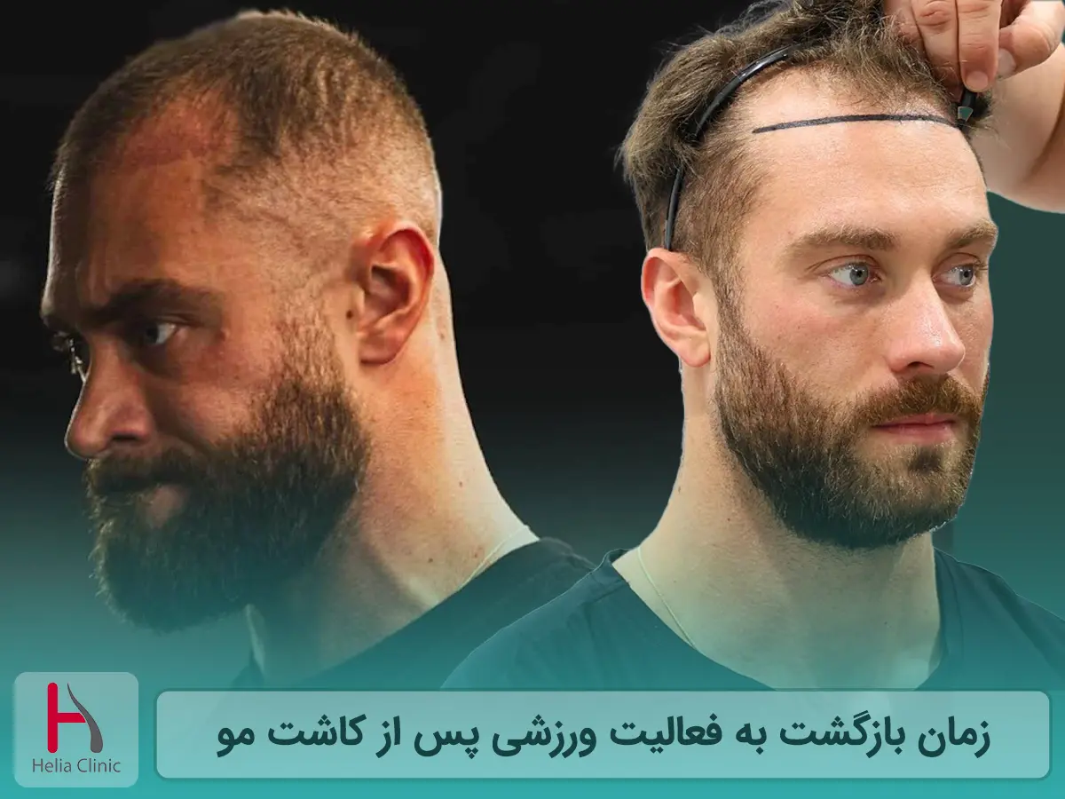 شروع ورزش بعد از کاشت مو