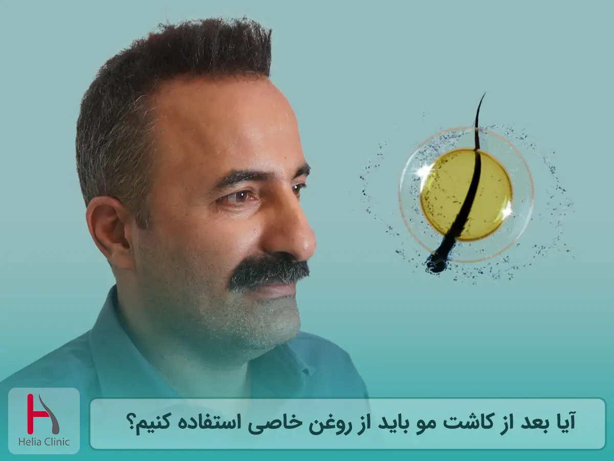 آیا بعد از کاشت مو باید از روغن خاصی استفاده کنیم؟