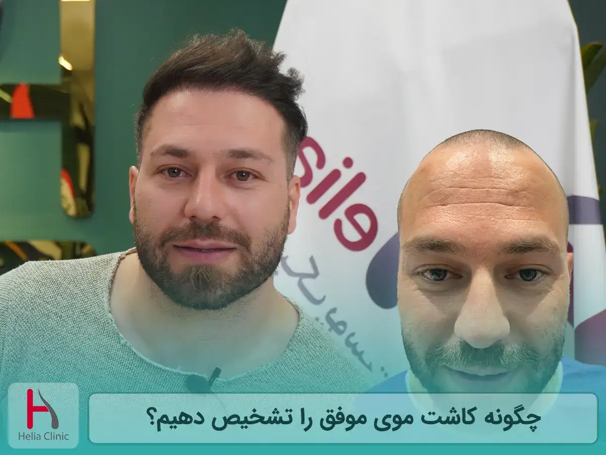 چگونه کاشت موی موفق را تشخیص دهیم؟