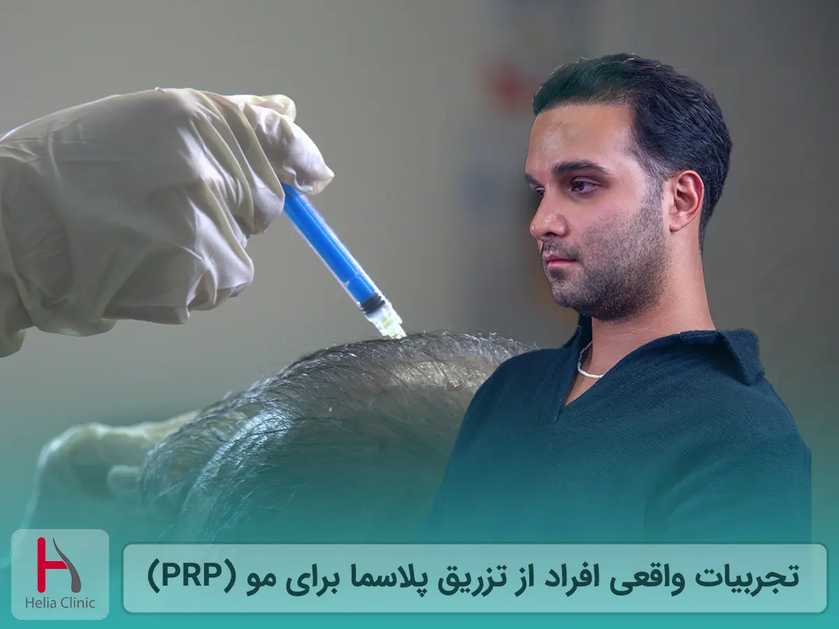 تجربه تزریق پلاسما به پوست سر: قبل وبعد
