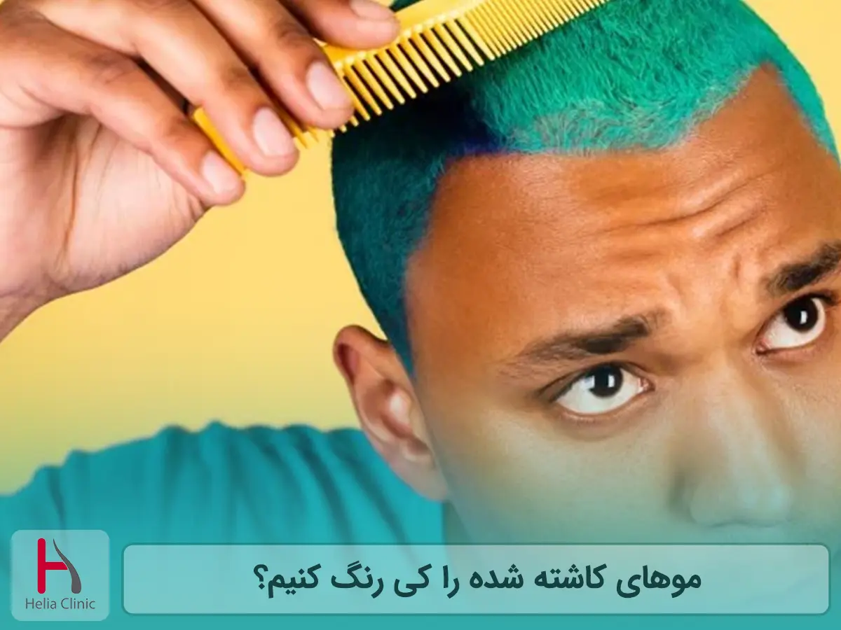 موهای کاشته شده را کی رنگ کنیم؟
