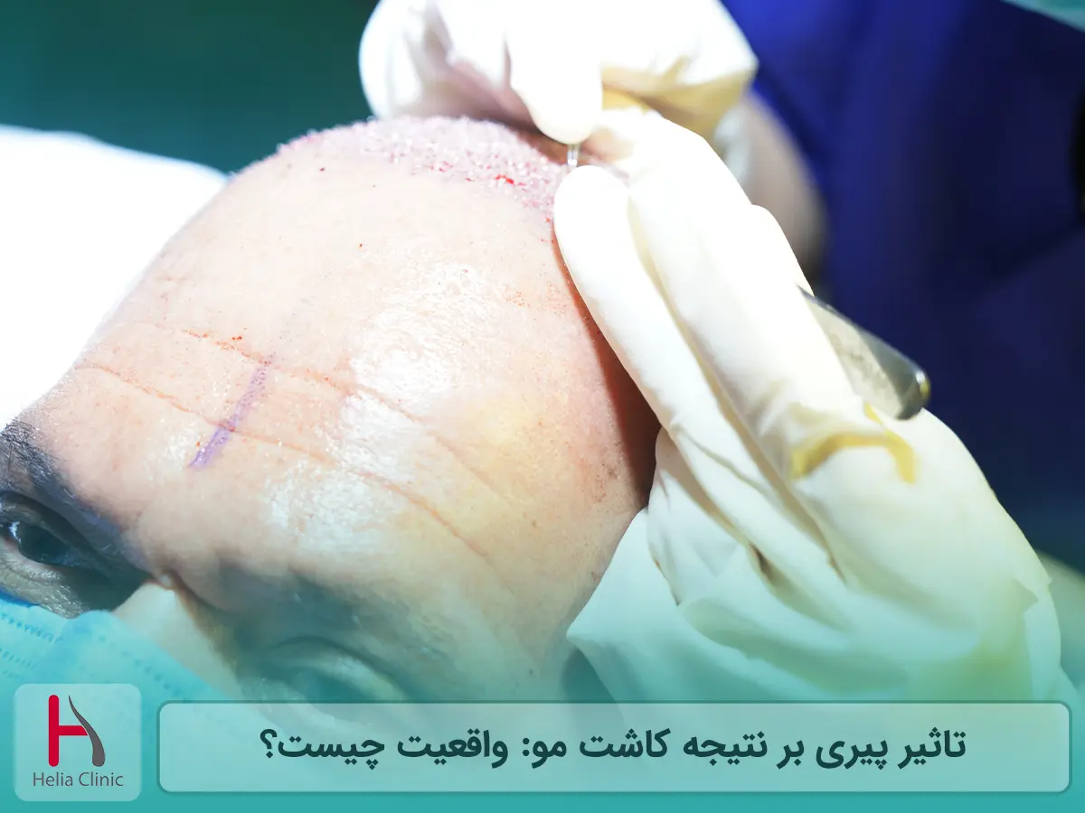 تاثیر پیری بر نتیجه کاشت مو: واقعیت چیست؟