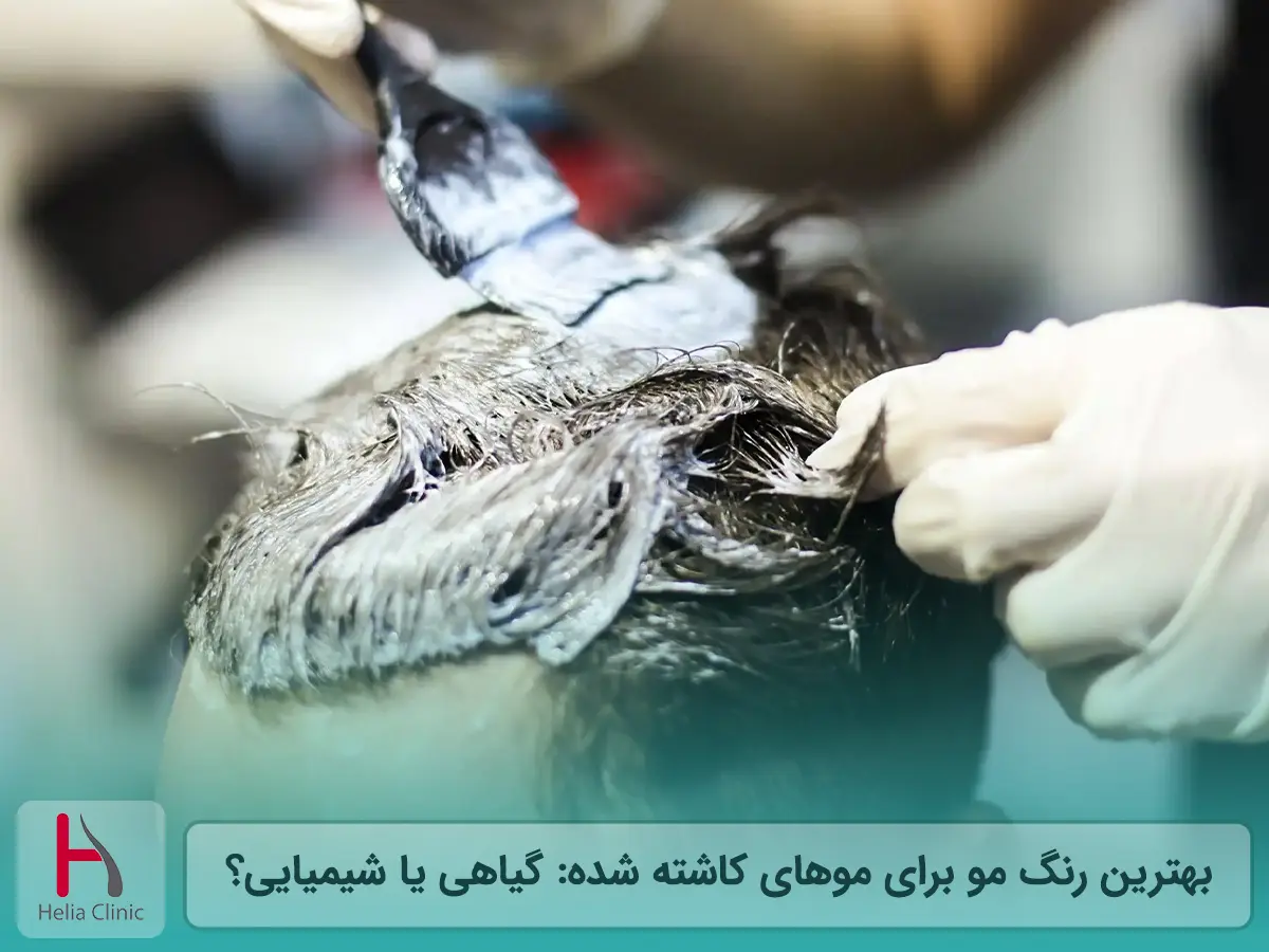 بهترین رنگ مو برای موهای کاشته شده: گیاهی یا شیمیایی؟
