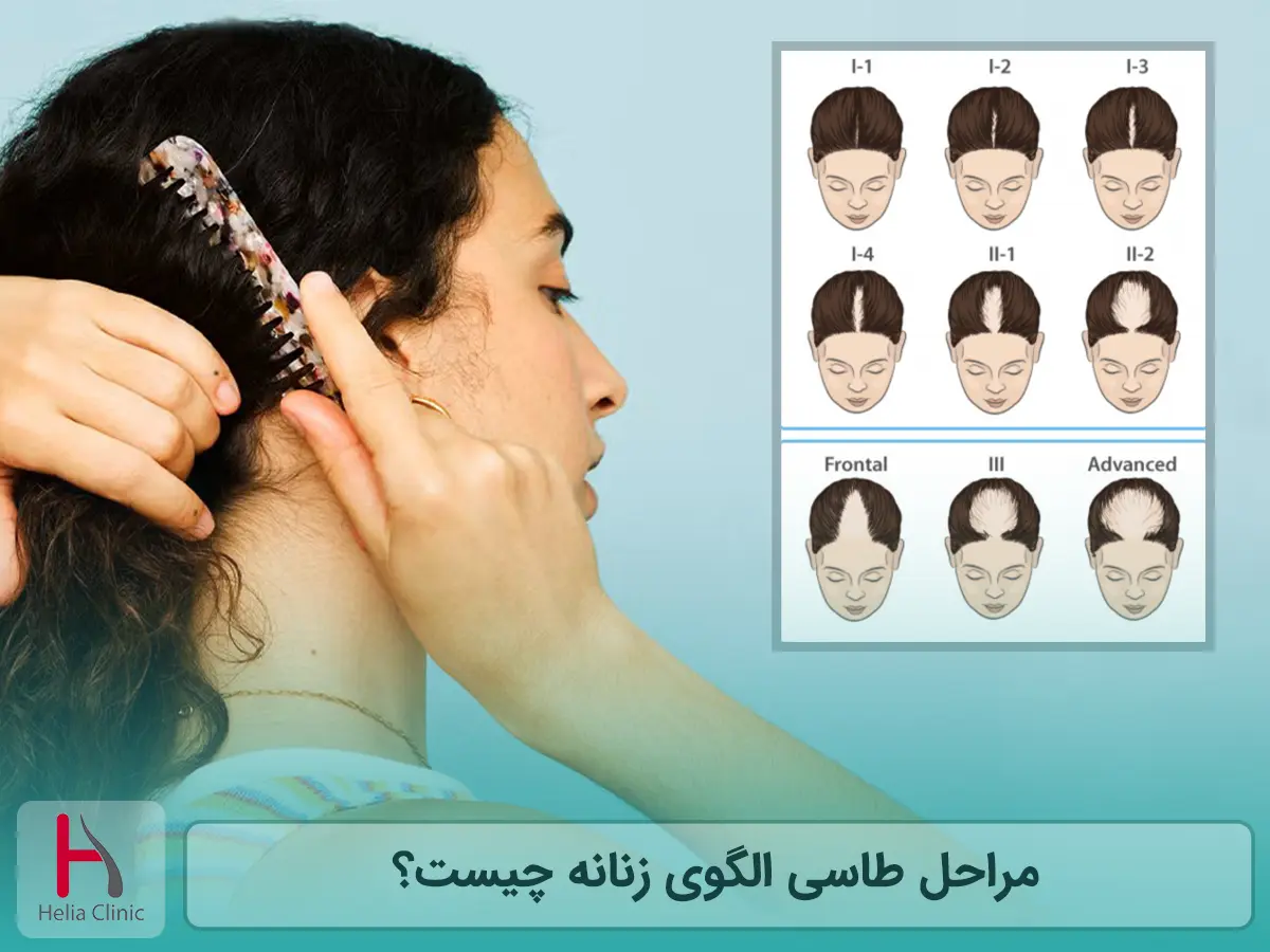 مراحل طاسی الگوی زنانه چیست؟
