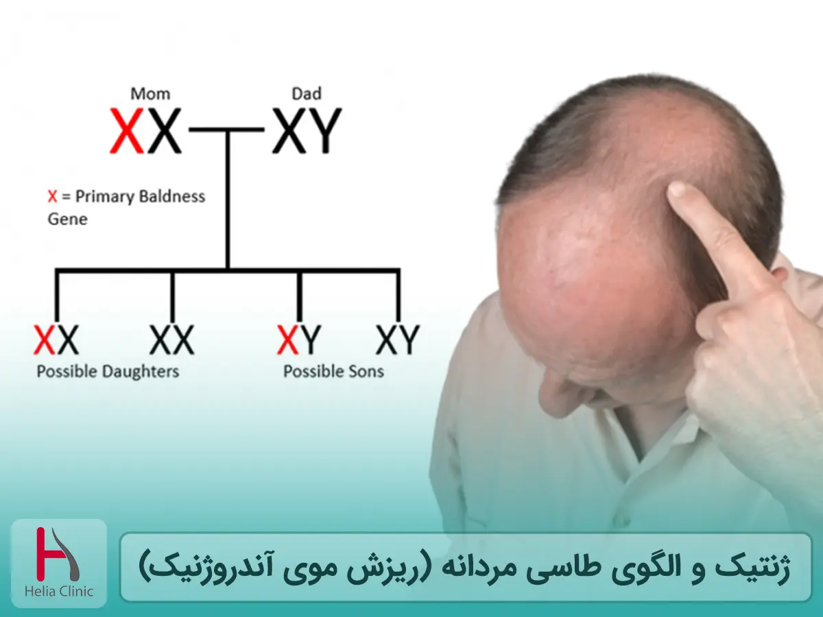 ژنتیک و الگوی طاسی مردانه