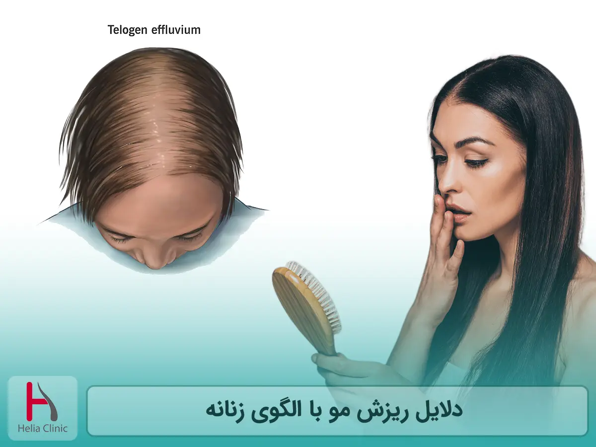 دلایل ریزش مو با الگوی زنانه
