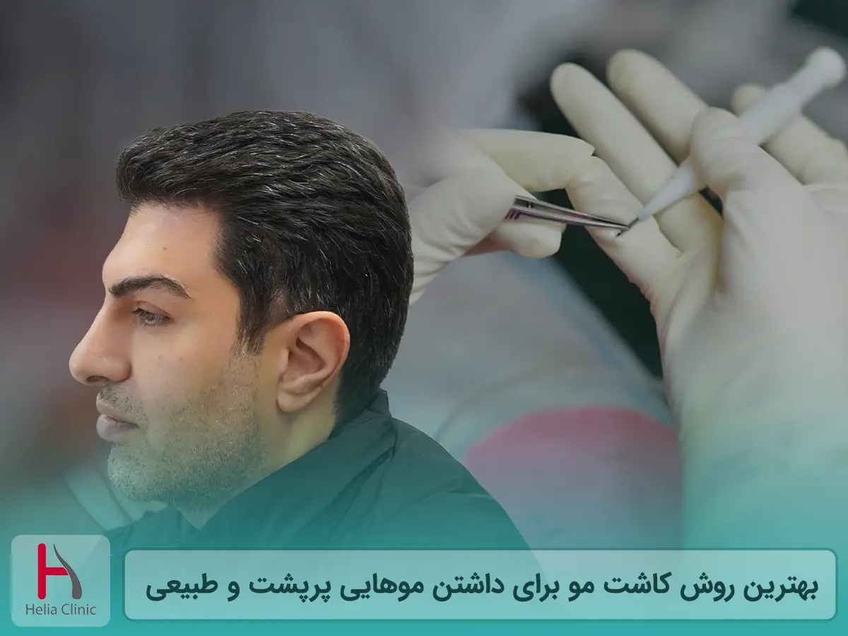 بهترین روش کاشت مو برای داشتن موهایی پرپشت و طبیعی