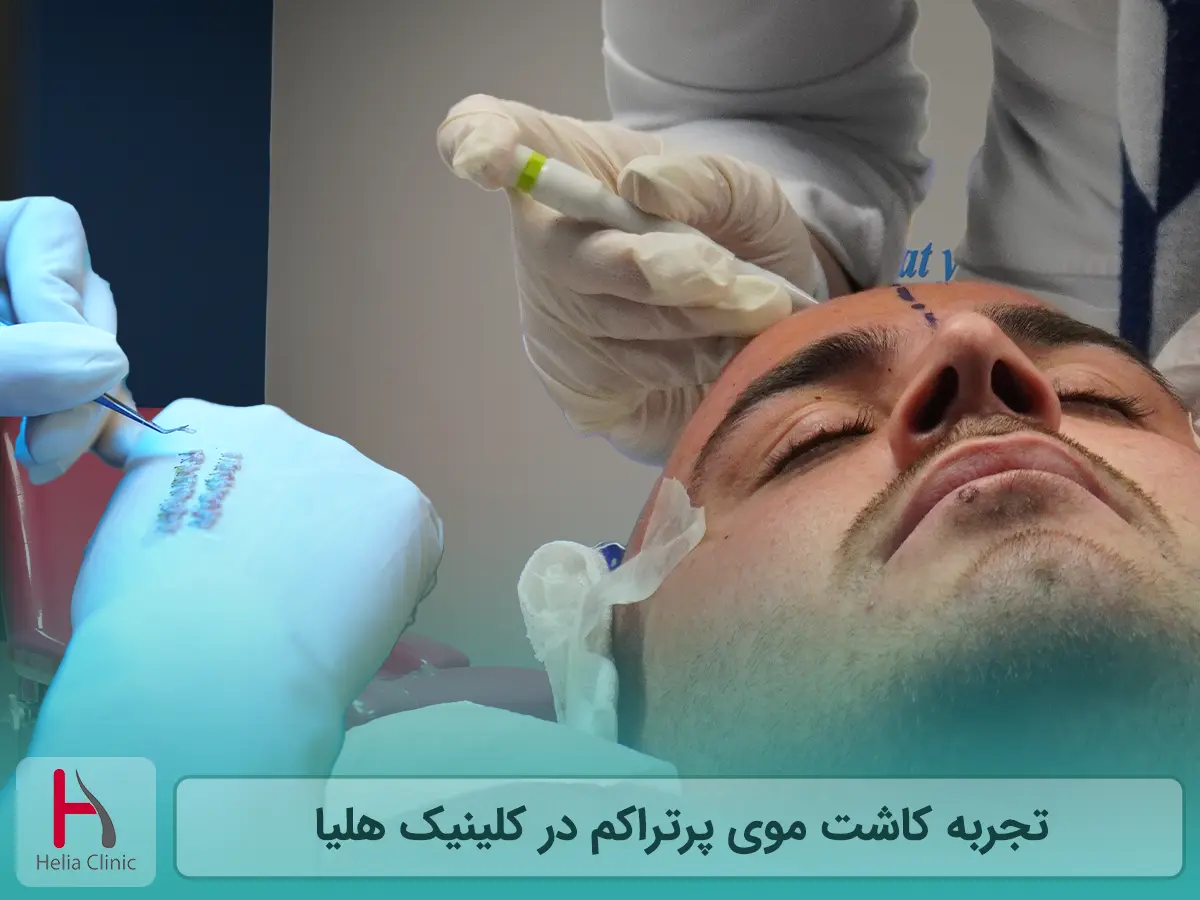 تجربه کاشت موی پرتراکم در کلینیک هلیا