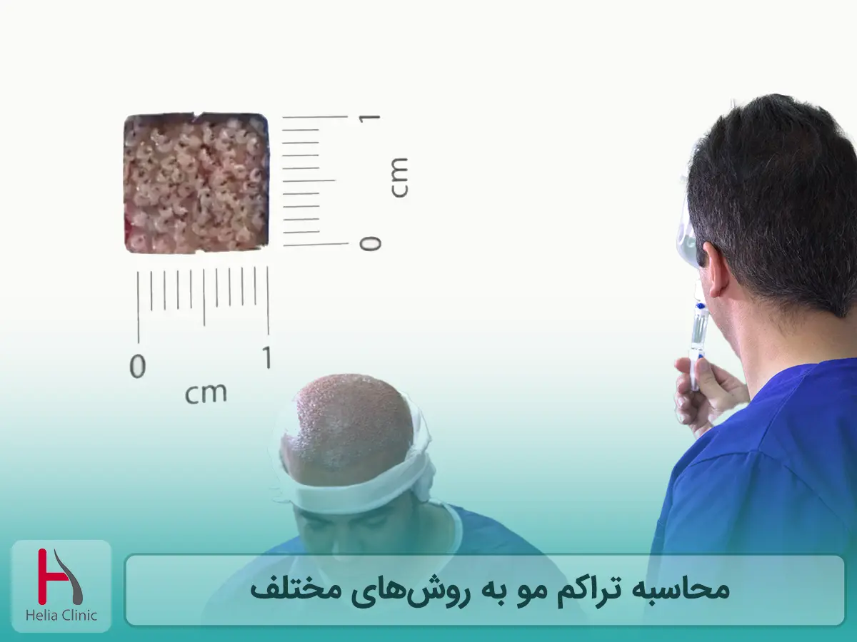 محاسبه تراکم مو به روش‌های مختلف