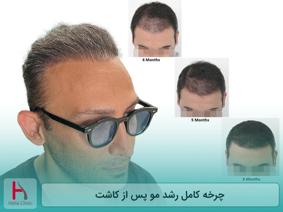 چرخه رشد مو بعد از کاشت از هفته ی اول تا یک سال
