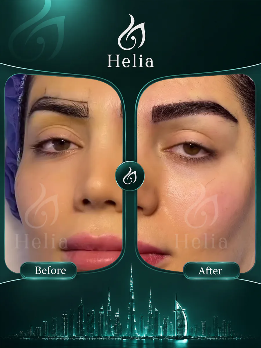 Eyebrow transplant before and after result 3
