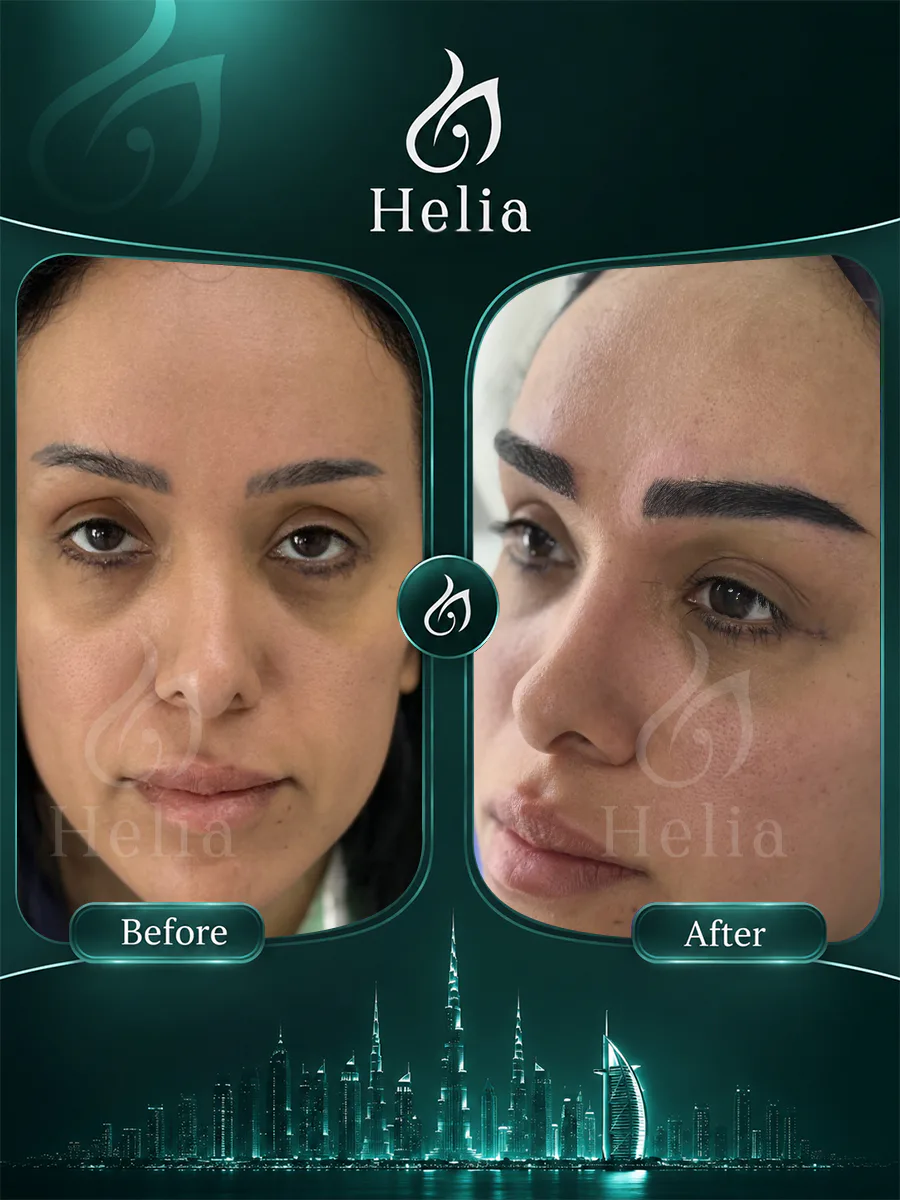 Eyebrow transplant before and after result 4