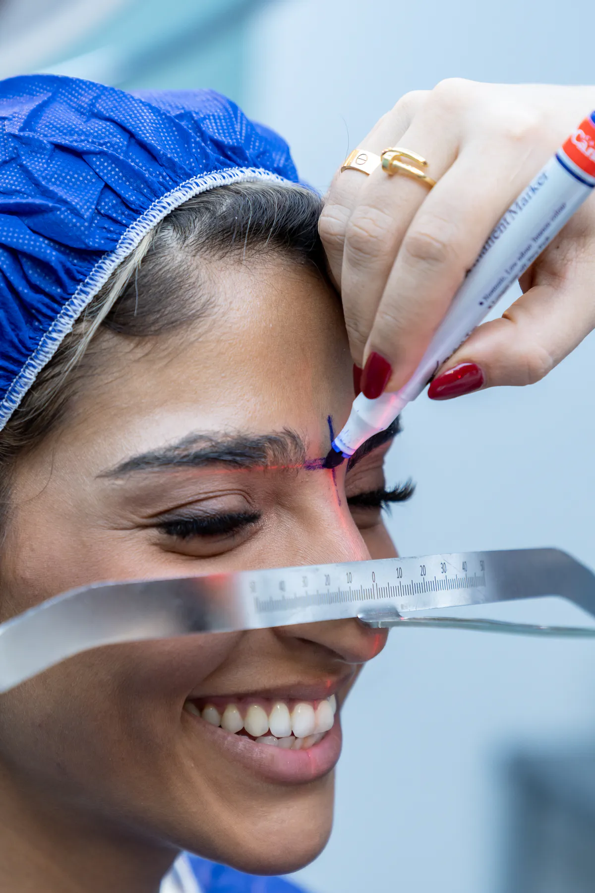 Precision eyebrow mapping with laser alignment before transplant
