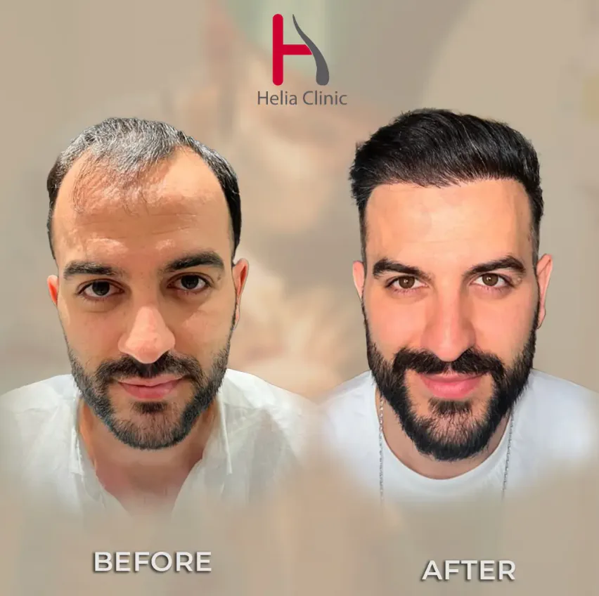 Before and after comparison of a successful hair transplant result for a male patient at Helia Clinic, showing full hair restoration.