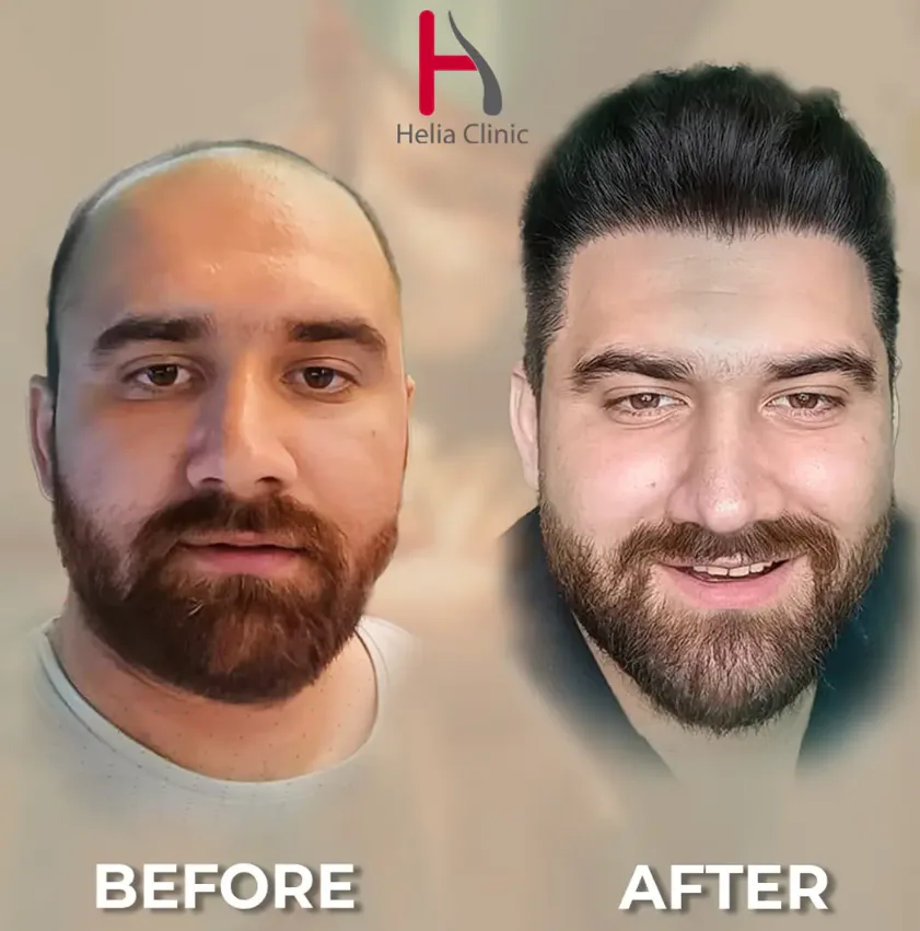 Before and after hair transplant results for a man at Helia Clinic, showing a transition from significant baldness to a full head of thick dark hair.