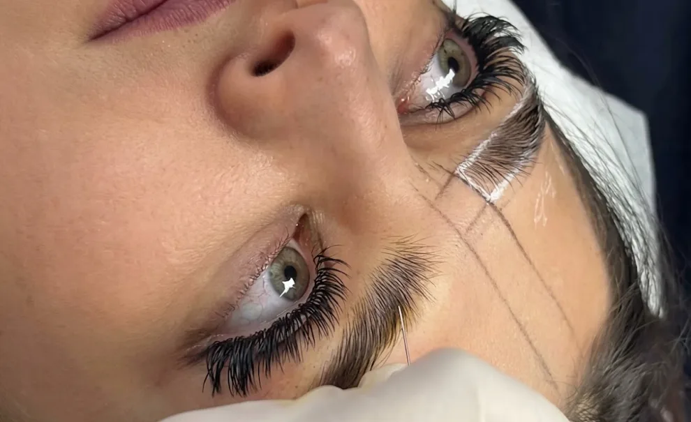 Eyebrow Transplant & Architectural Restoration Dubai