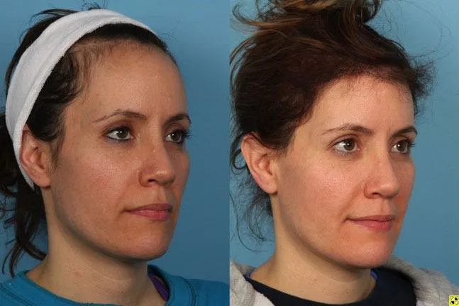 Before and after female hair transplant at Helia Clinic Dubai showing a lowered and more defined feminine hairline.