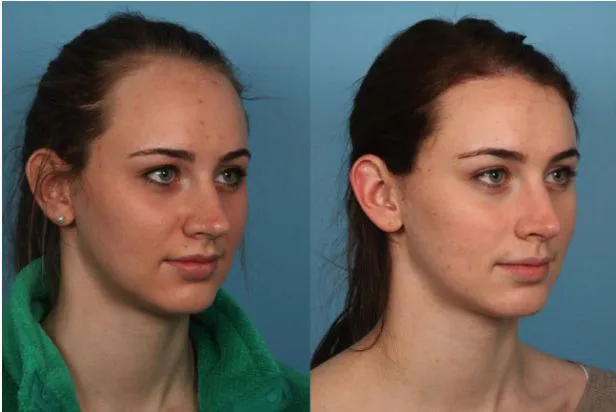 Before and after female hairline restoration at Helia Clinic Dubai with denser temples and frontal hairline.