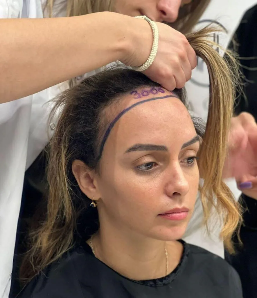 Choi Micro-Implanter female protocol at Helia Clinic Dubai — dense, voluminous natural hair after gentle no-shave restoration.