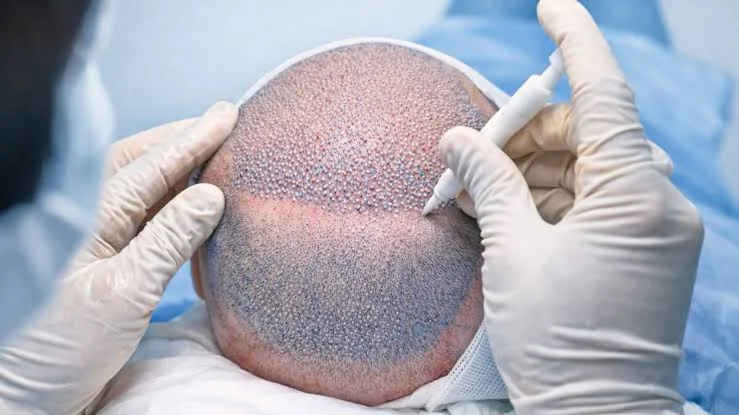 DHI hair transplant procedure using Choi implanter at Helia Clinic Dubai