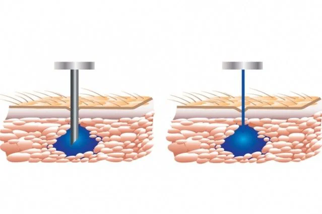 Needle-free jet injector for painless hair transplant anesthesia at Helia Clinic Dubai