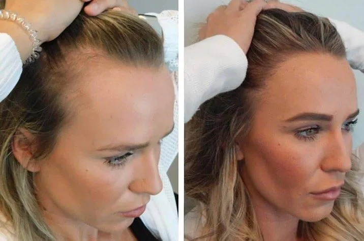 Hairline transplant before and after at Helia Clinic Dubai — natural frontal hairline restoration.