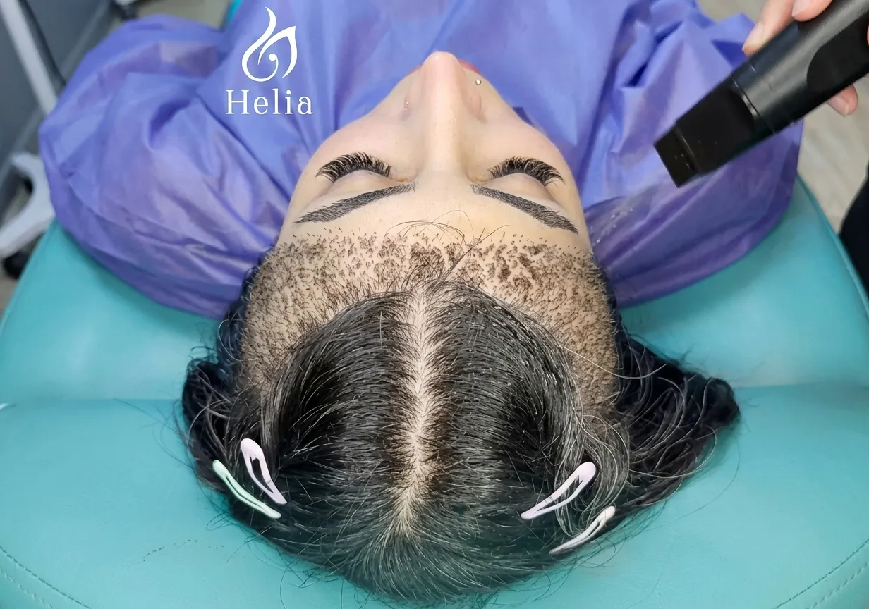 Hairline transplant for receding hairline and hairline restoration at Helia Clinic Dubai.