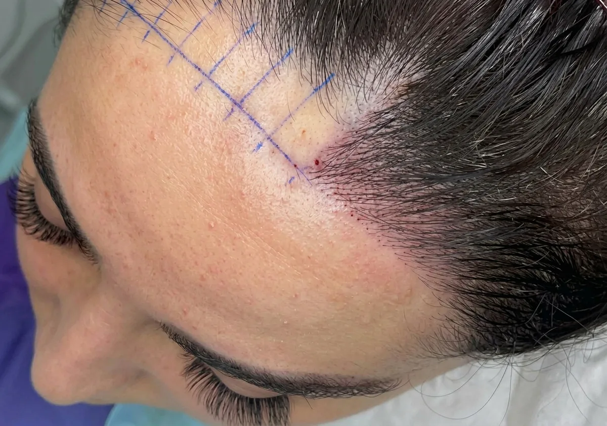 Hairline transplant at Helia Clinic Dubai — improved frontal density.