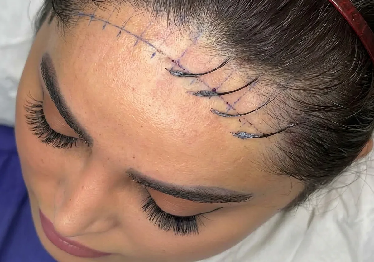 Hairline transplant at Helia Clinic Dubai — restored natural frontal hairline.