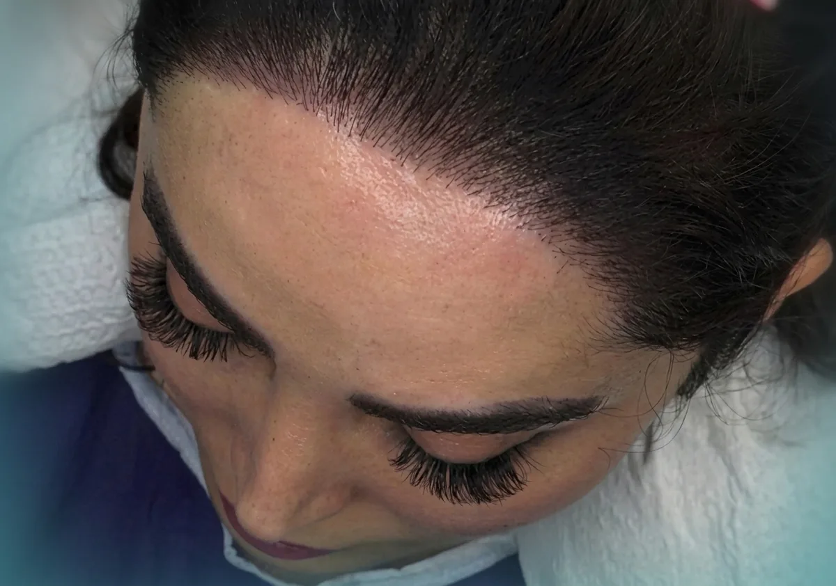 Hairline transplant at Helia Clinic Dubai — refined temples and hairline shape.
