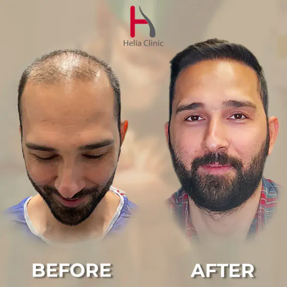 Before and after revision and corrective hair transplant at Helia Clinic Dubai showing repaired density and a more natural hairline.