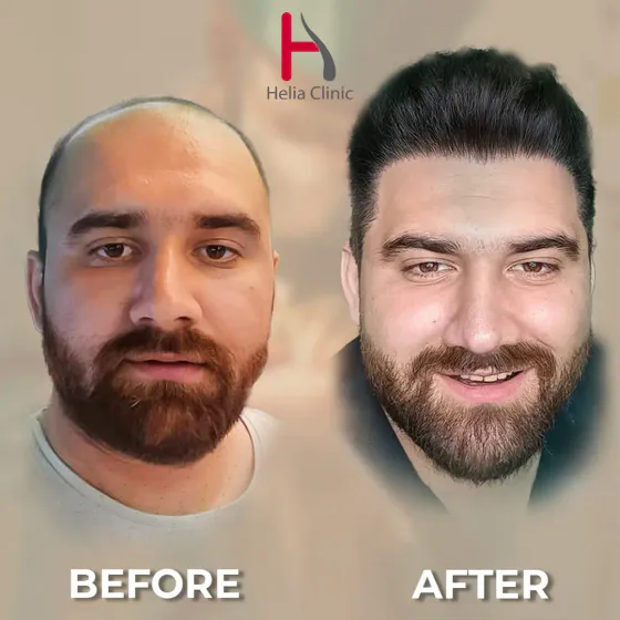 Before and after corrective hair transplant at Helia Clinic Dubai with improved frontal coverage after a previous procedure.