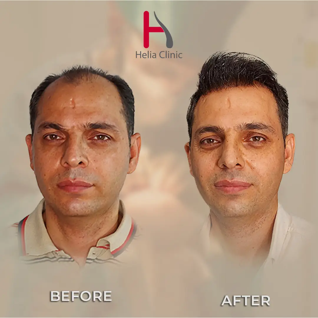 Frontal Hairline Lowering & Temple Reconstruction – after