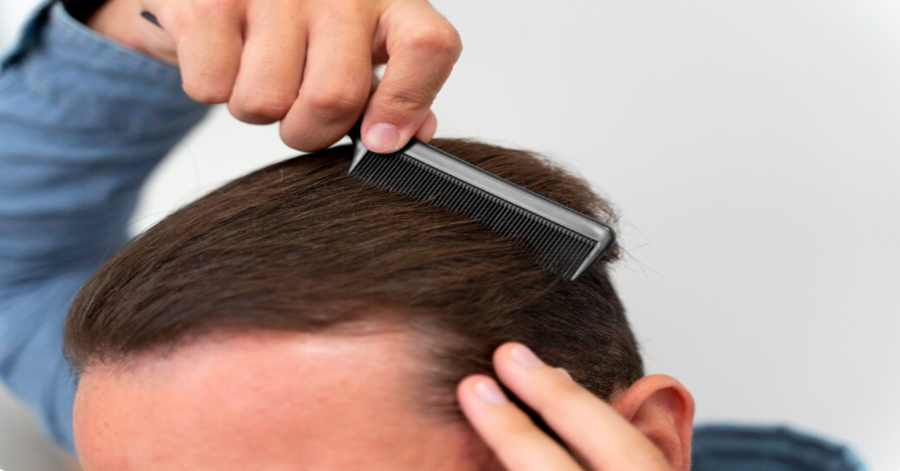 Care Before and After Hair Transplant: A Step-by-Step Guide