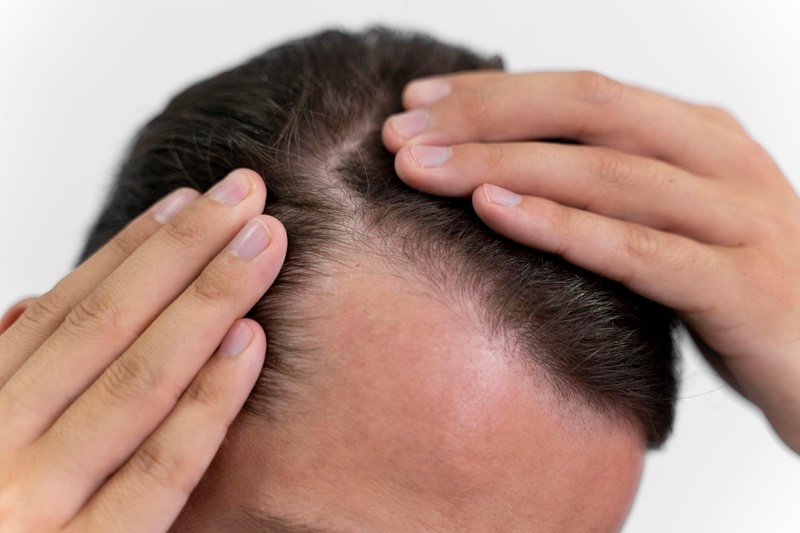 Male pattern hair loss