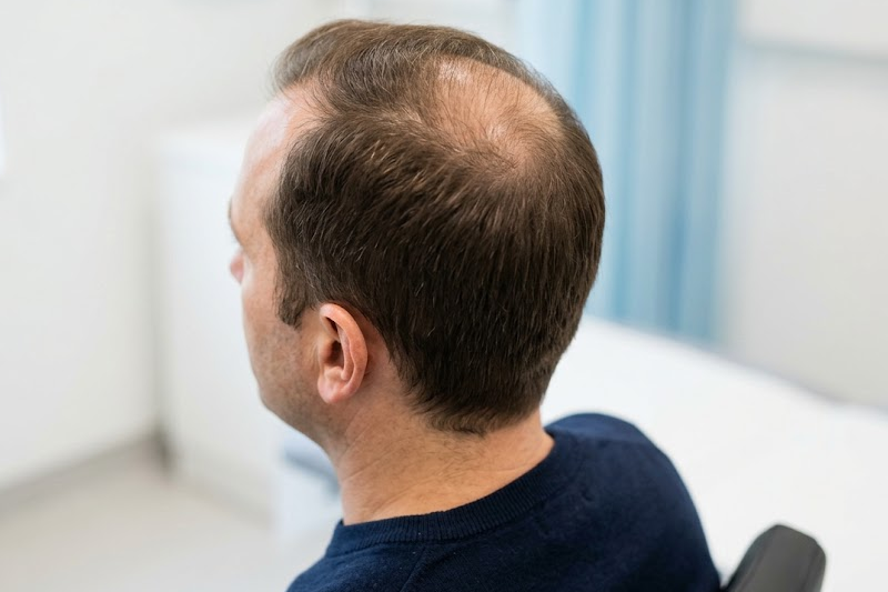 Hair transplant grafts on a man's scalp