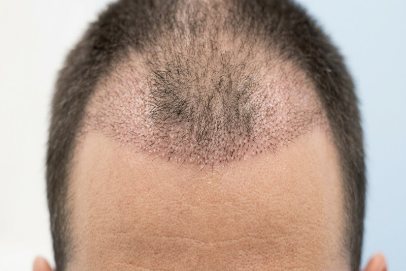 Hair transplant recovery process