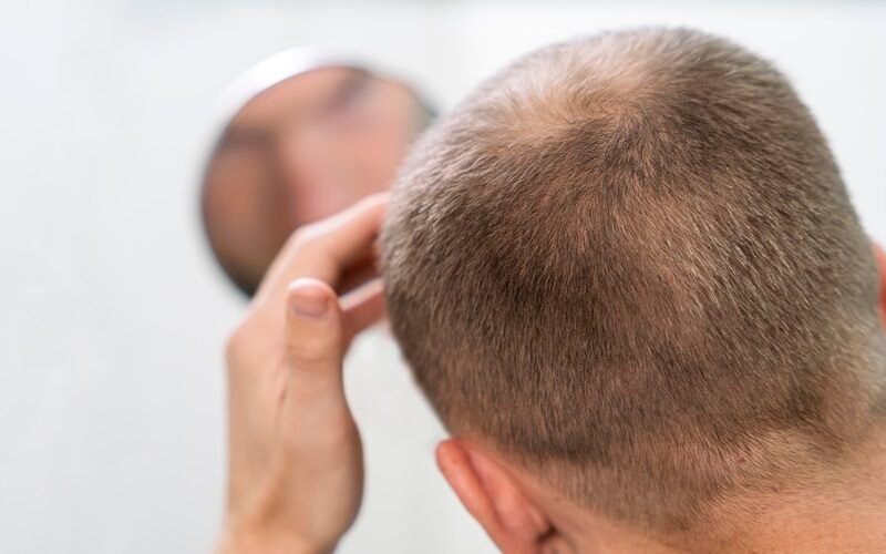 Hair Loss: A Complete Guide to Causes, Types & Treatments