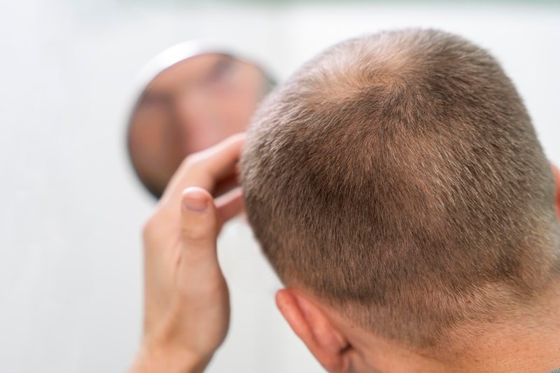 Hair Loss: A Complete Guide to Causes, Types & Treatments