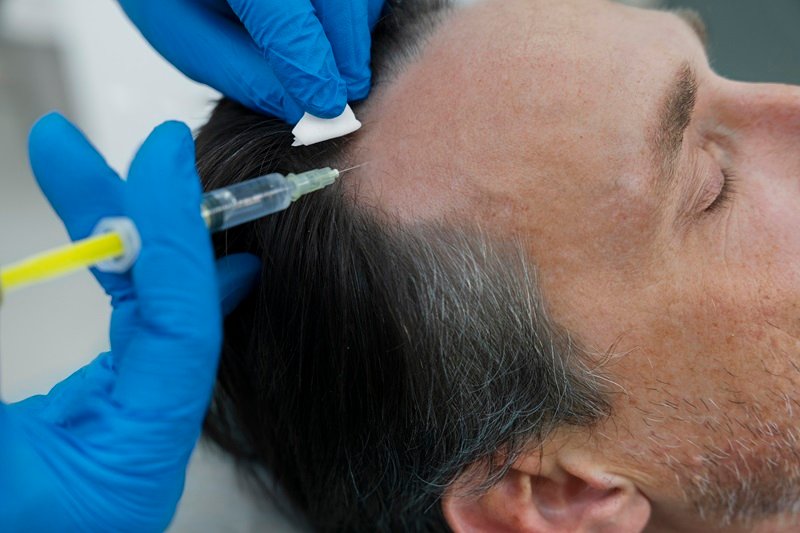 Hair mesotherapy treatment with microinjections into the scalp